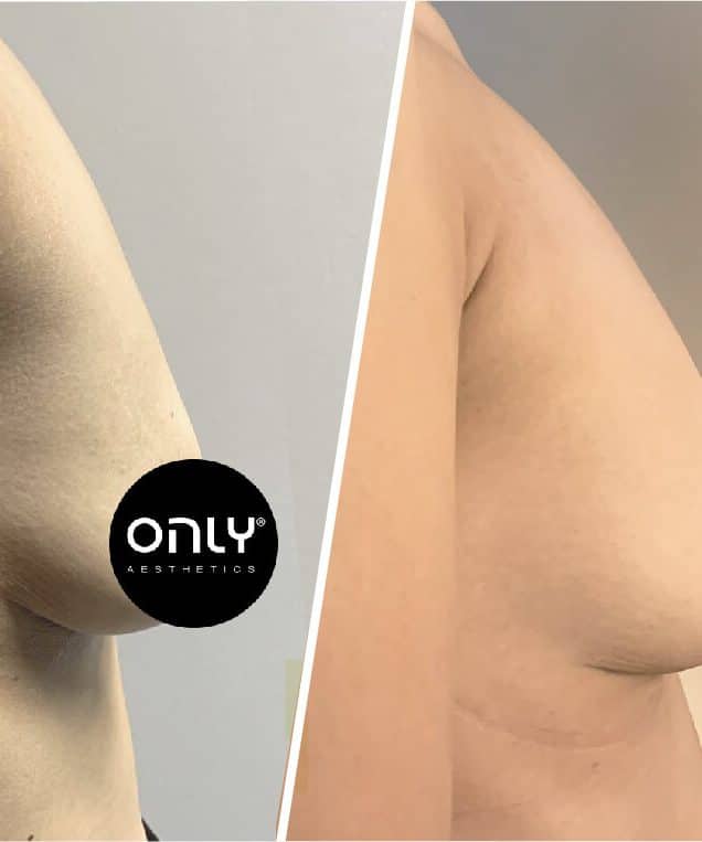 ONLIUPSIZE® TRIAL PER SESSION