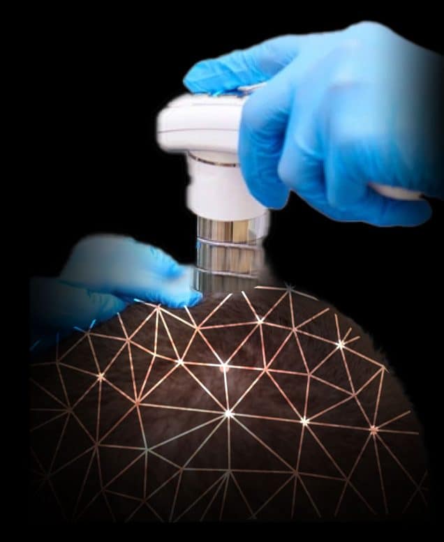 TRICHONLY®️ MALE HAIR LOSS & THINNING TRIAL