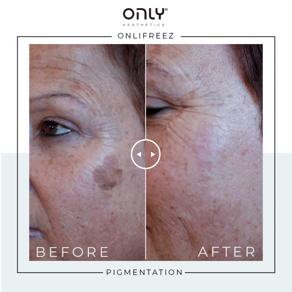 Before and After Images of Pigmentation Removal For ONLIFreez treatment