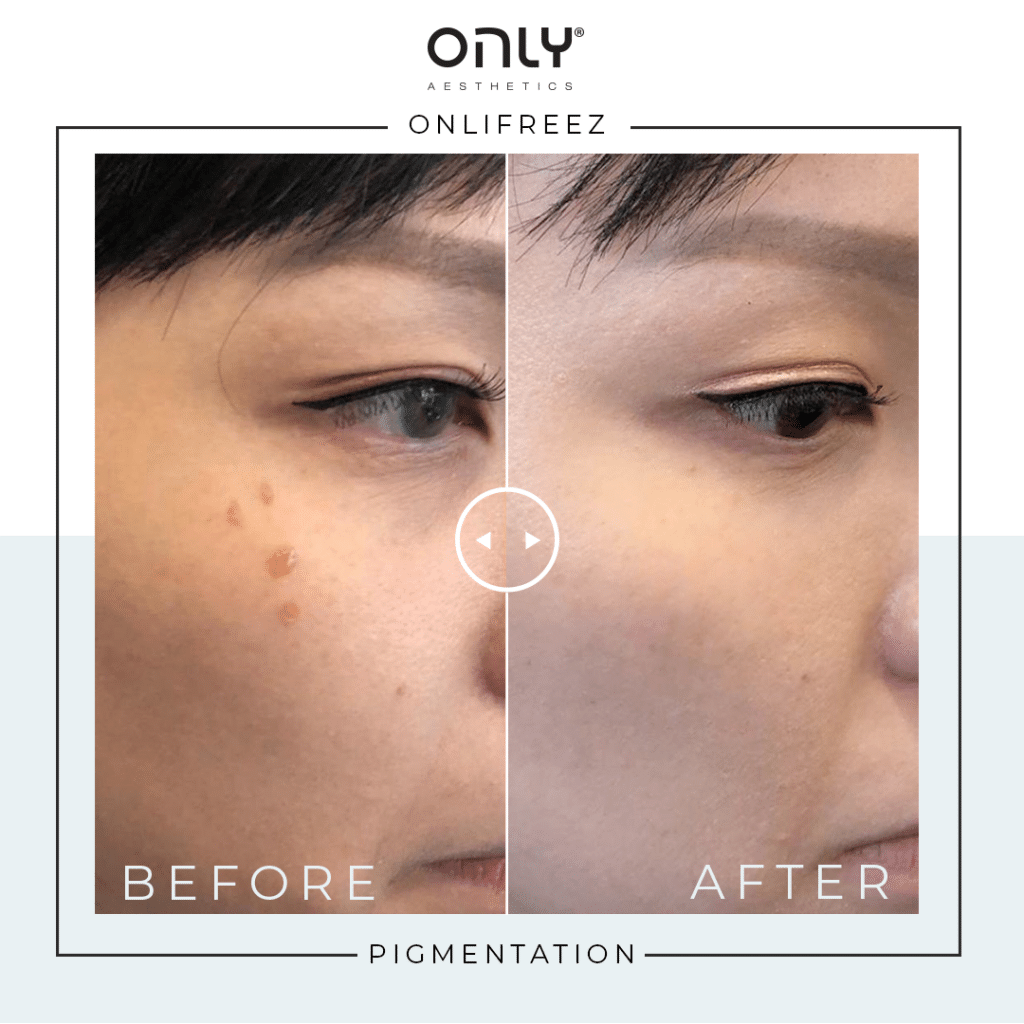 Before and After Images of Pigmentation Removal For ONLIFreez treatment