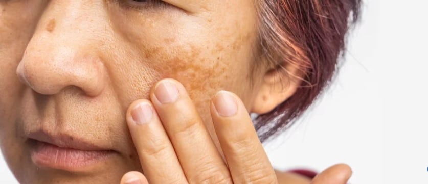 In this ultimate guide to laser pigmentation removal in Singapore, discover how to achieve a flawless complexion and reduce the appearance of pigmentation.