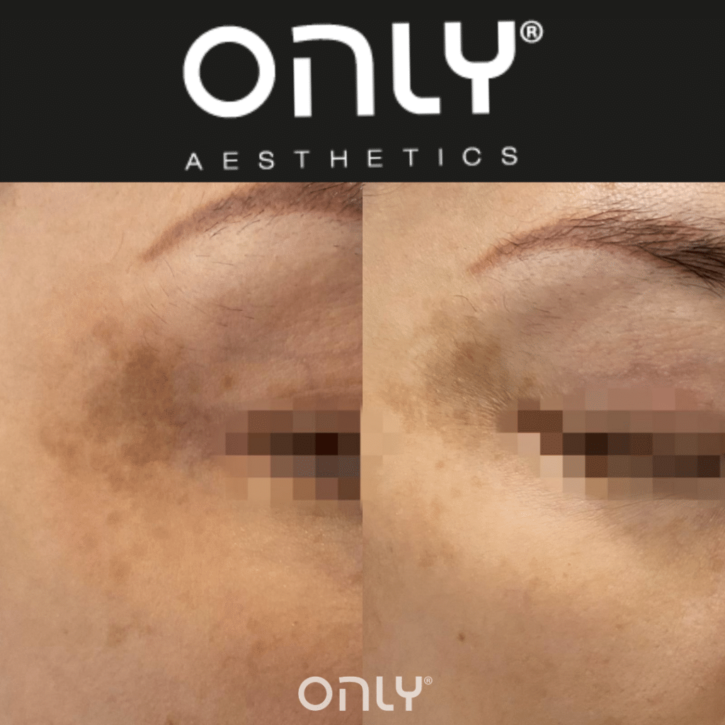 Before and After Images of Pigmentation Removal For ONLIFreez treatment
