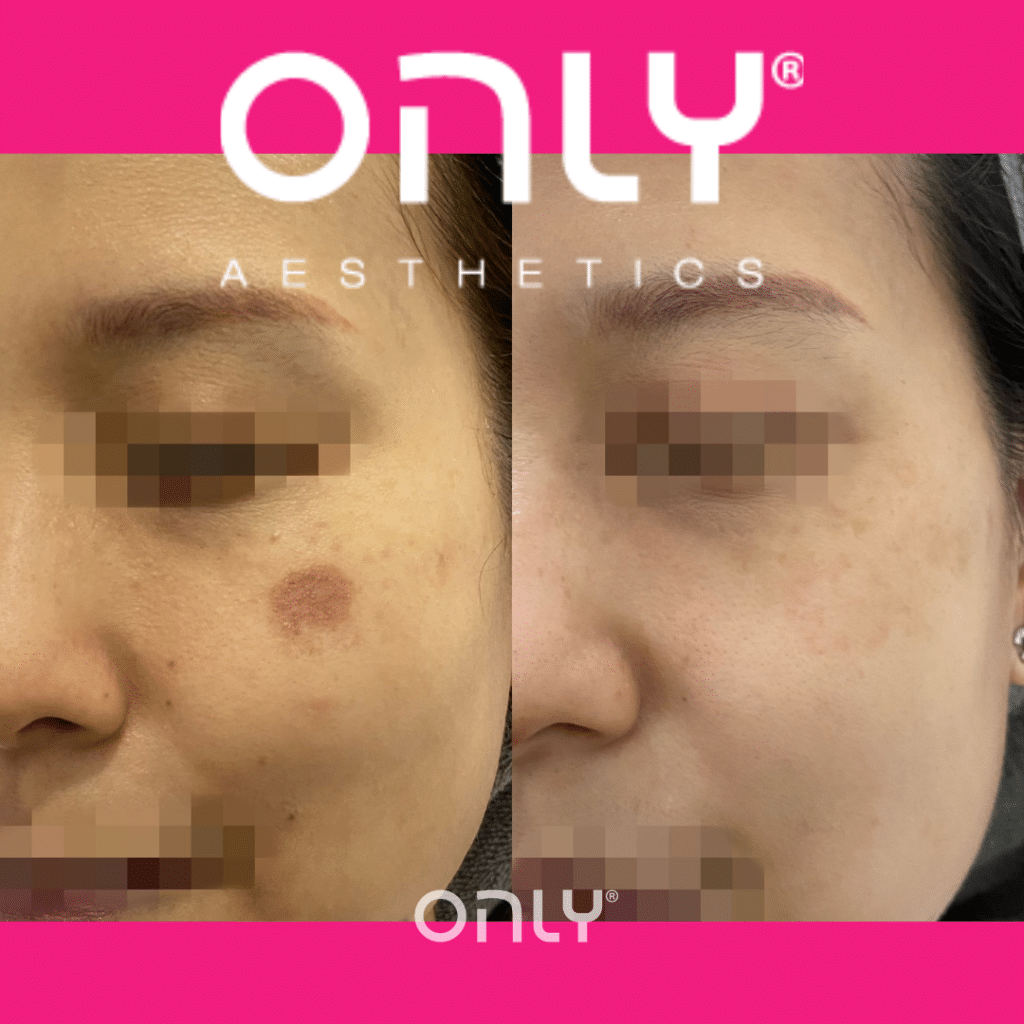 Before and After Images of Pigmentation Removal For ONLIFreez treatment