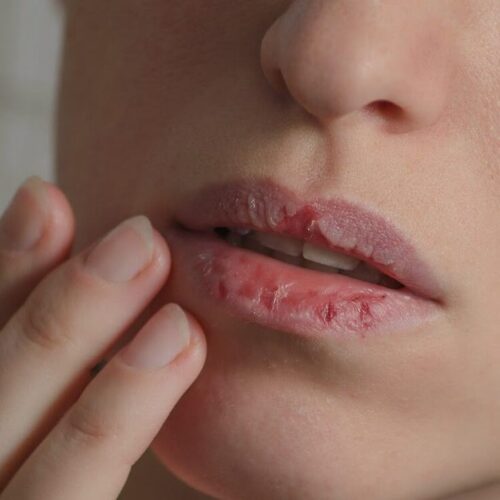 ONLYPink LiPink is Singapore’s best dark lip lightening treatment. Get natural, pink lips safely & effectively with this advanced solution!
