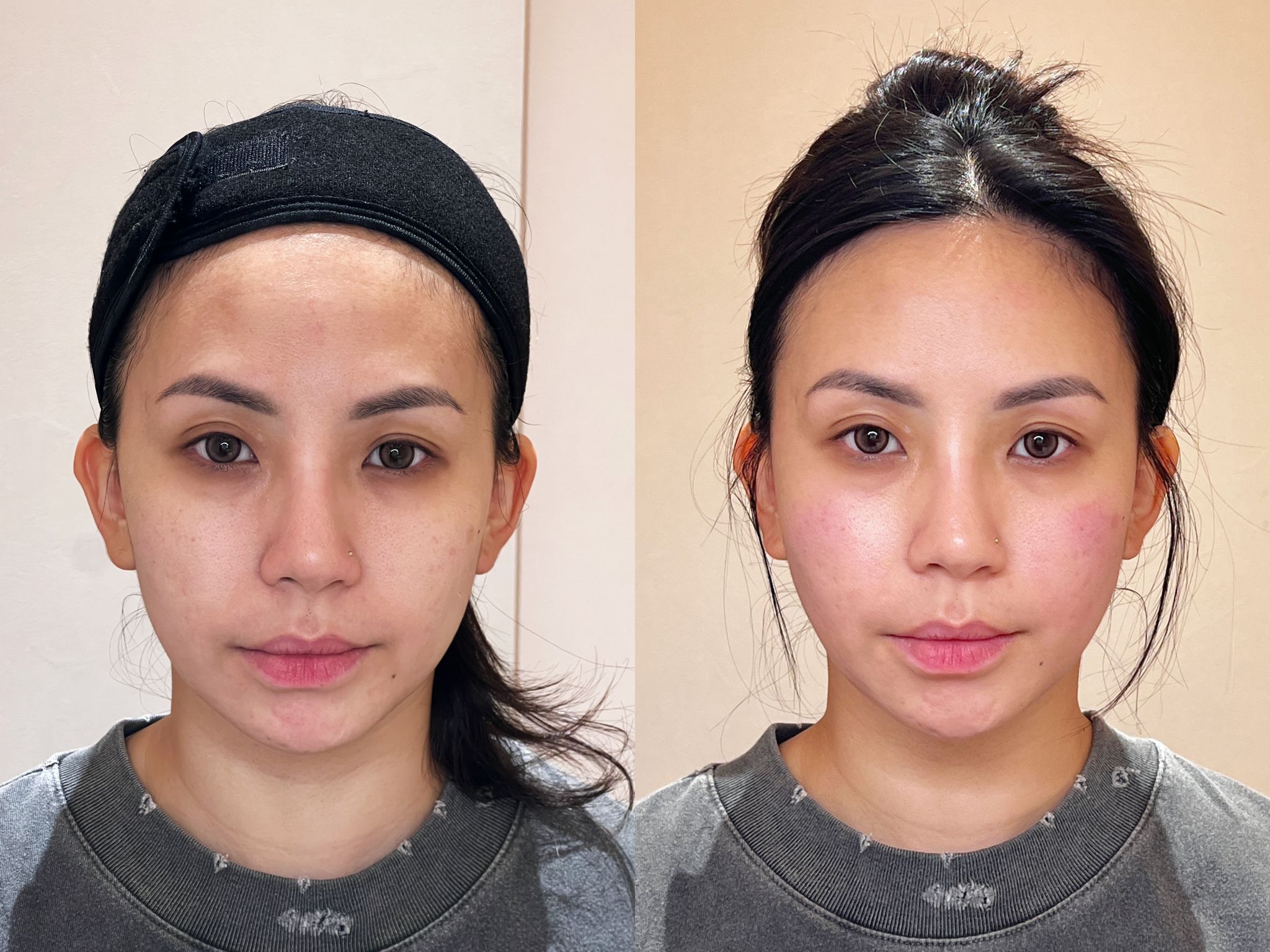 Woman receiving non-surgical face lifting treatment in Singapore