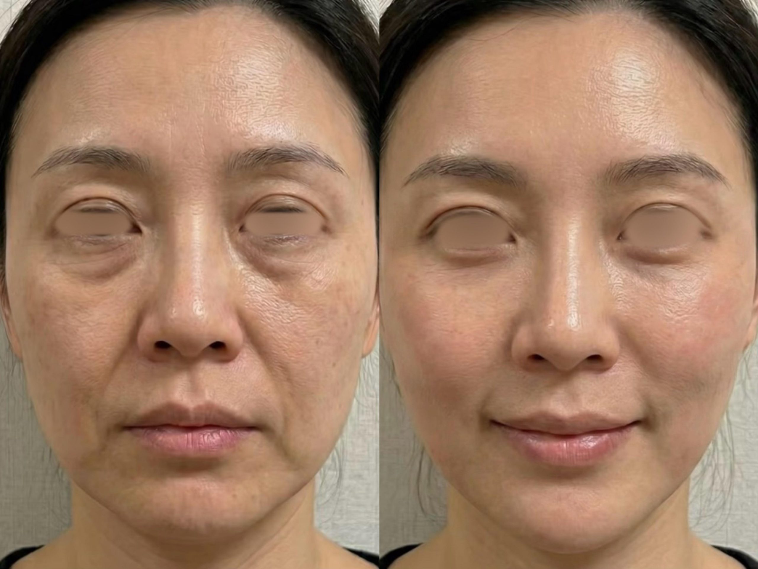 Before and after under-eye area, ONLYLift™ face lifting treatment
