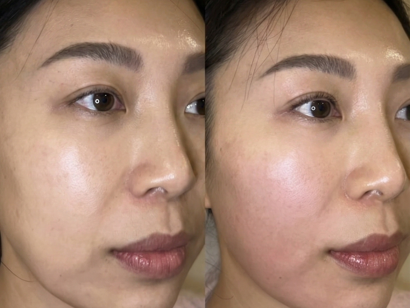 Before and after cheek definition, ONLYLift™ face lifting treatment